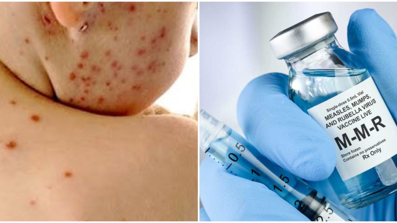 হাম ঠেকাতে জরুরি মিশনে সরকার