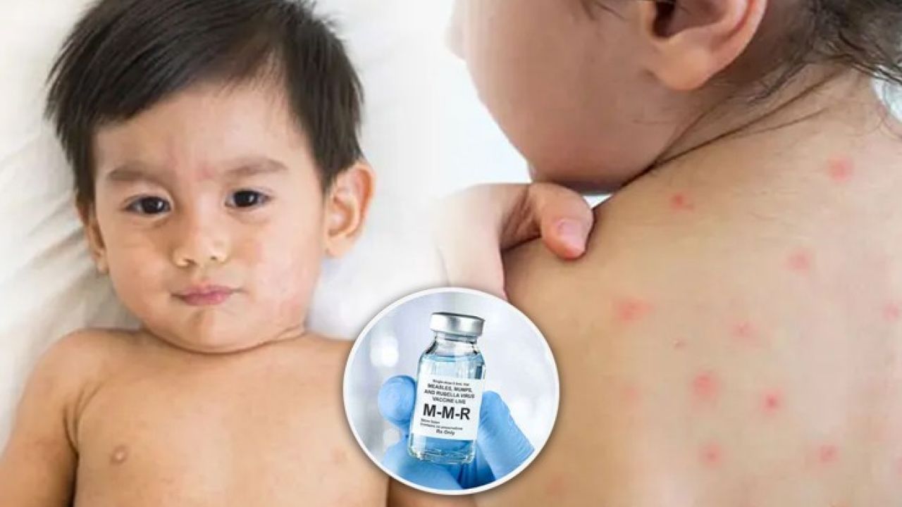 সারা দেশেই হাম, বাড়ছে শিশু মৃত্যু