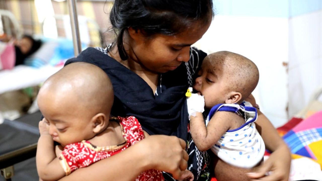 হামে আরও ১৭ শিশুর মৃত্যু, আক্রান্ত ৪৭ হাজার ছাড়াল