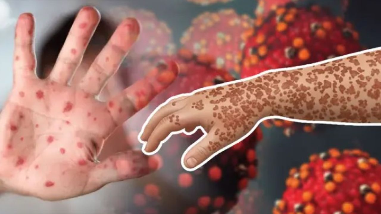 ২৫০০ বছর আগে গরু থেকে আসা হাম, কীভাবে ছড়ালো বিশ্বময়?