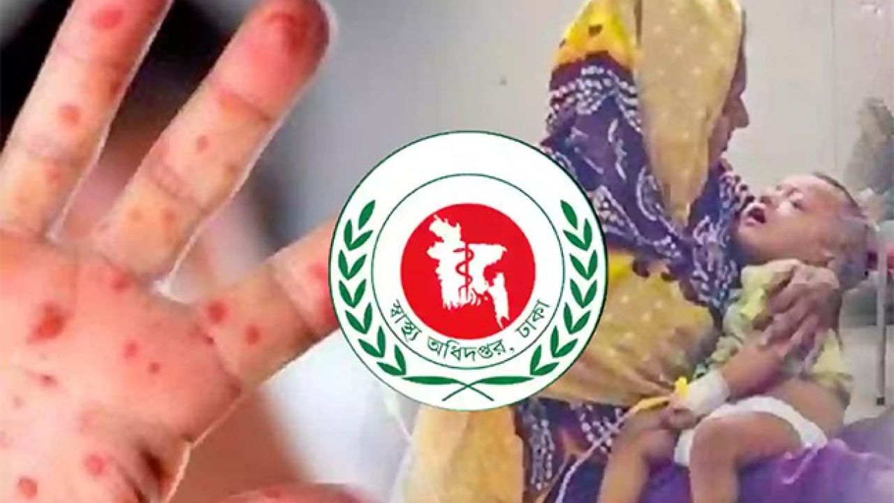 হামের থাবায় আরও ৫ শিশুর প্রাণহানি, নতুন আক্রান্ত প্রায় দেড় হাজার