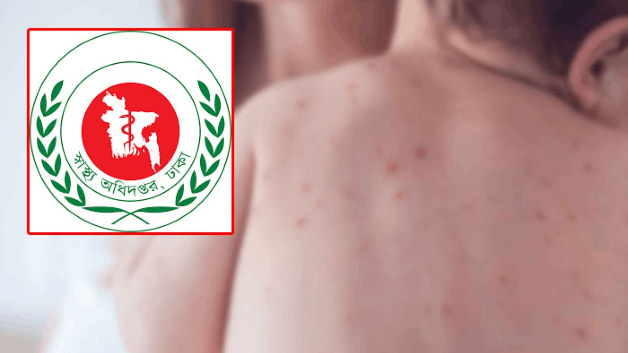 হামে মোট মৃত্যু ৫৮৫ শিশু, আক্রান্ত ৭৯,৯৮৫ শিশু