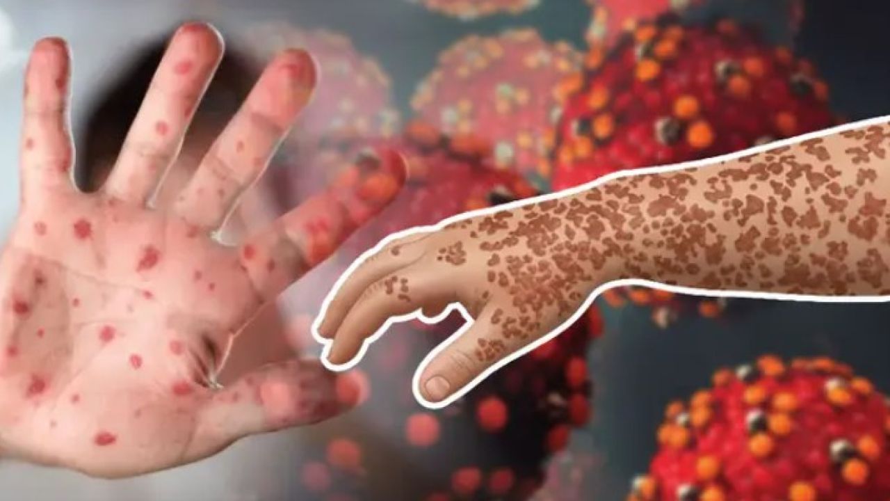 হামে আরও ৫ শিশুর প্রাণহানি, মৃত বেড়ে ৬৪৮
