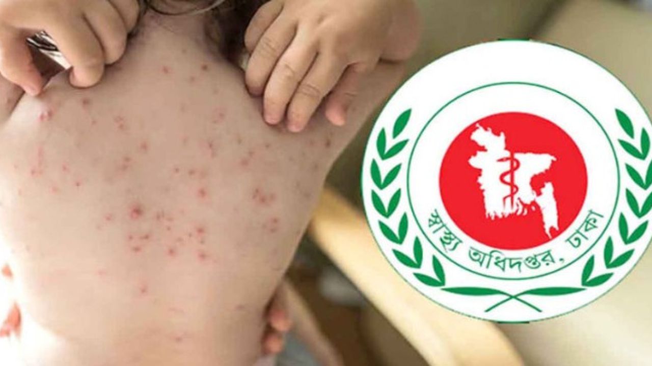 হাম ও উপসর্গে আরও ৬ শিশুর মৃত্যু