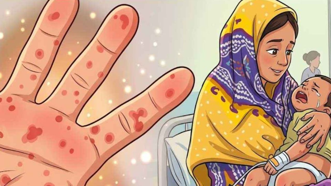 হামে প্রাণ গেল আরও ৭ শিশুর, মৃত্যু ৬০০ ছাড়াল