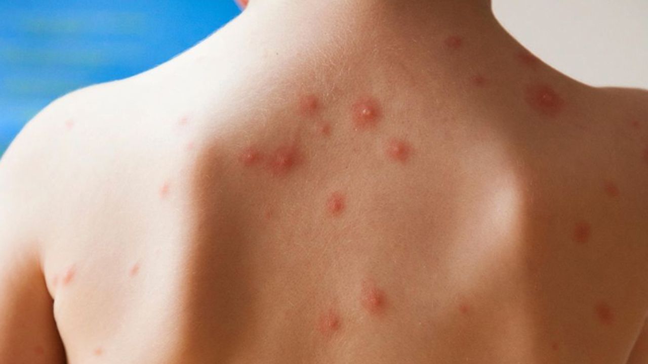 হাম না চিকেনপক্স? কীভাবে চিনবেন সহজেই