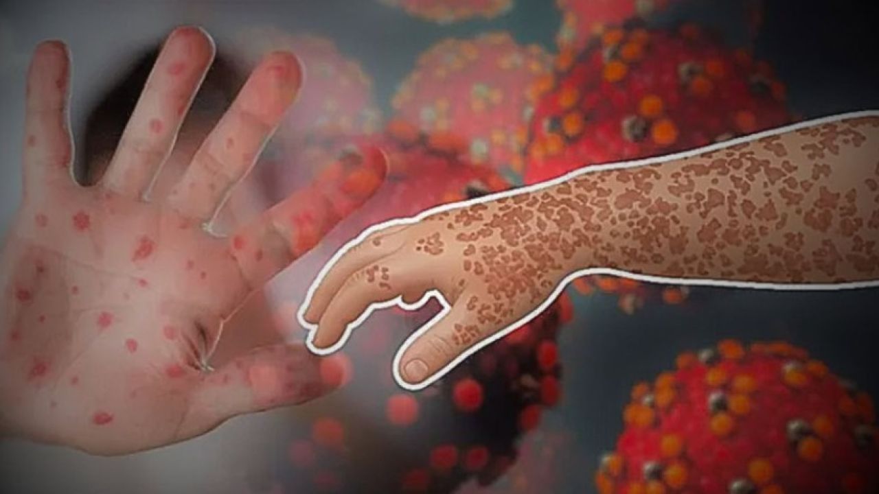 হামে প্রাণহানি বেড়ে ৭০৮, আক্রান্ত লাখ ছুঁইছুঁই