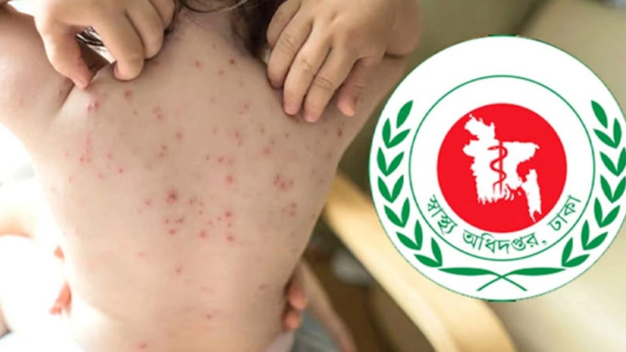 ২৬ দিনেই হামে মৃত্যু ১০০, মোট ৮০০ ছুঁই ছুঁই