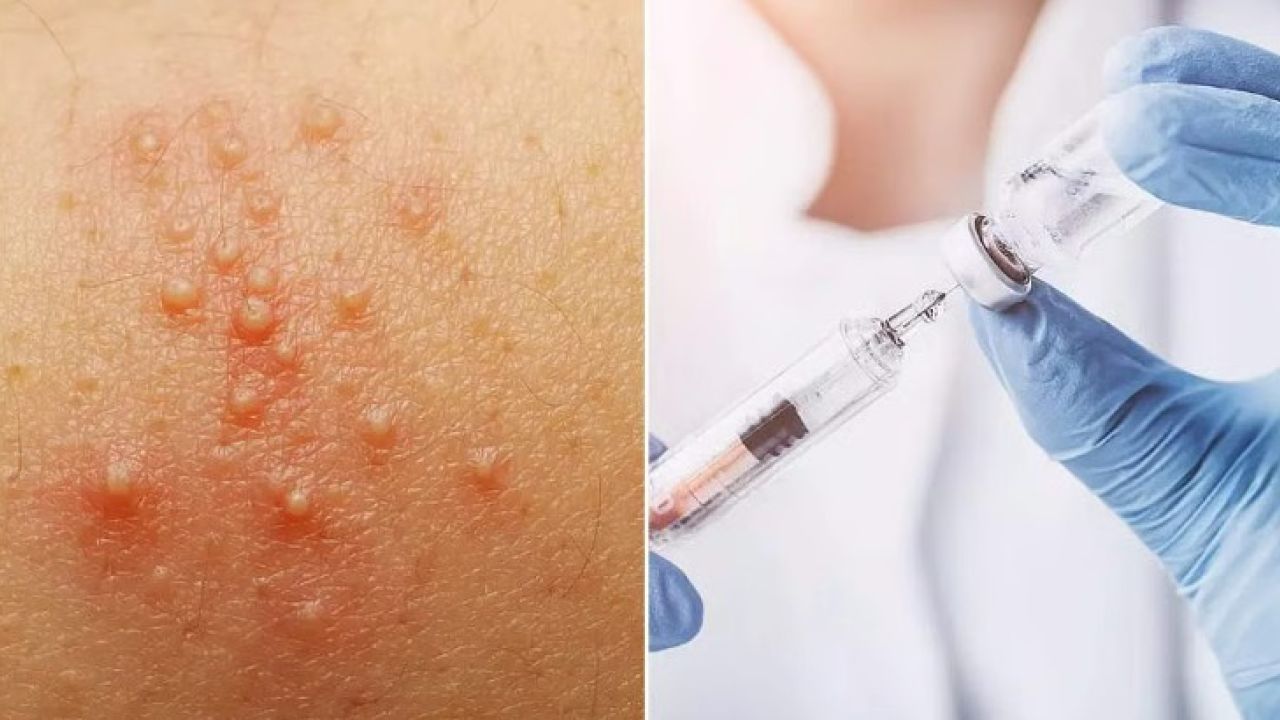 হামে আরও ৫ শিশুর মৃত্যু, আক্রান্ত ১১৩৭