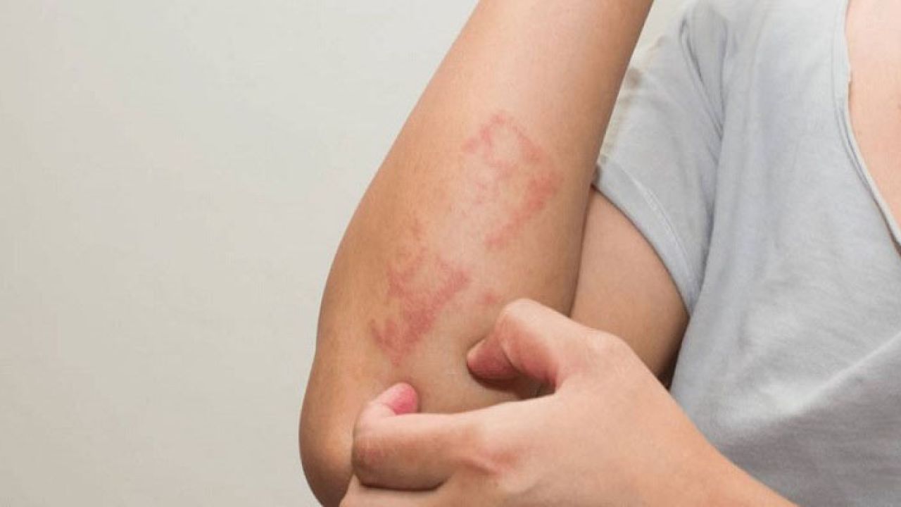 র‍্যাশ নেই, তবু সারা গায়ে চুলকানি?