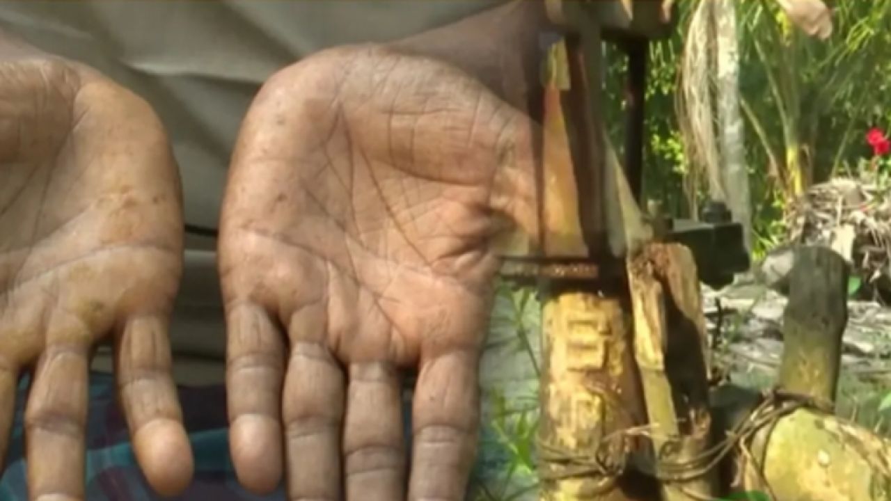 তালায় আর্সেনিকের মারাত্মক প্রভাব: স্বাস্থ্যঝুঁকিতে গ্রামবাসীরা