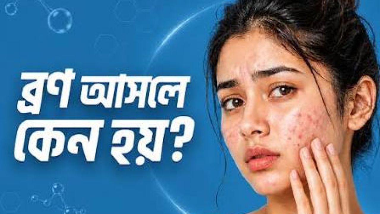 পিরিয়ডের আগে মুখে ব্রণ ওঠে কেন, নিয়ন্ত্রণে রাখার উপায়