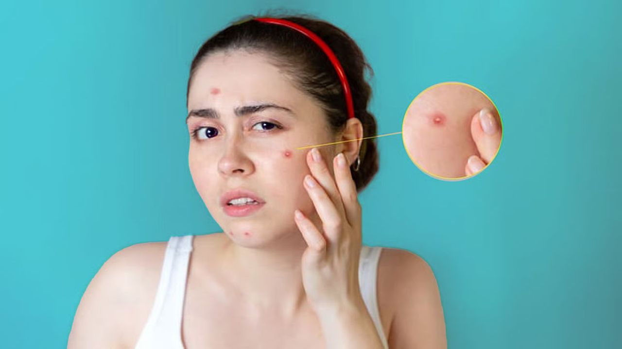 মুখে ব্রণ নিয়ে উৎসবের প্রস্তুতি? ত্বক ভালো রাখতে মানুন নিয়ম